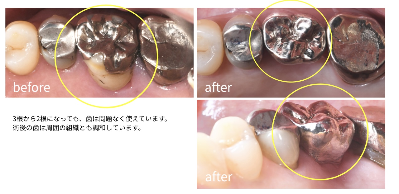 【症例紹介】インプラントを避けたい方へ。歯を残すために行った精密根管治療と歯根分割の症例
